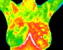 breast_thermography