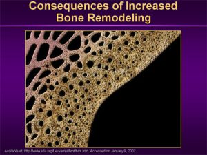 bone remodeling