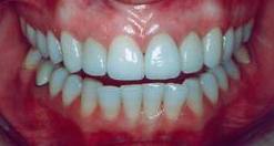 Healthy_Gums