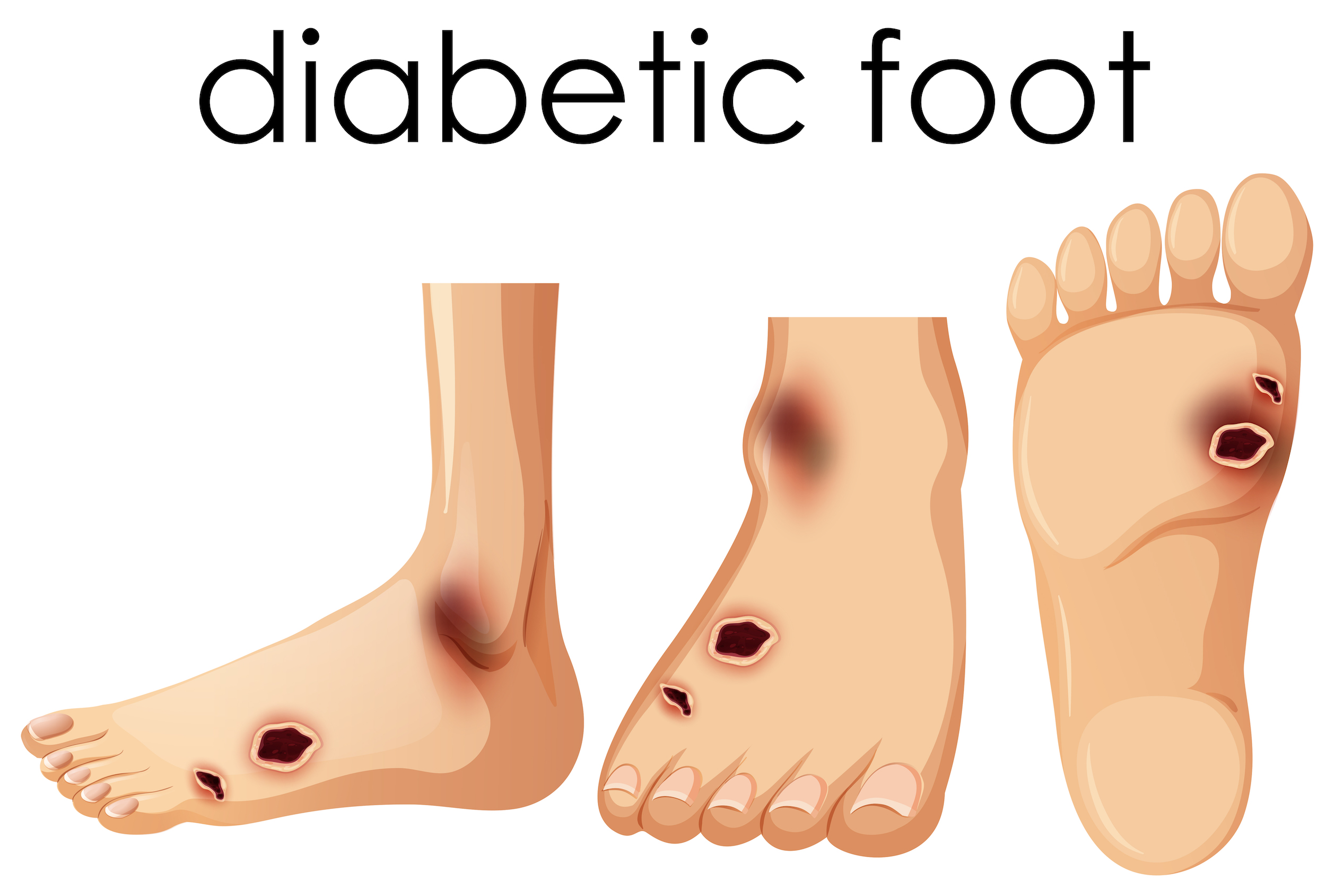 human foot cartoon-diabetic.jpg